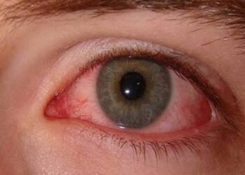 आई फ्लू के मरीजों की संख्या दिन पर दिन बढ़ रही