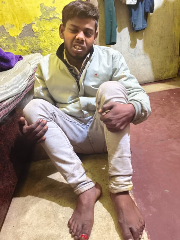 आगरा पुलिस हुई बेलगाम, इस बार जीवनी मंडी चौकी पुलिस ने दी थर्ड डिग्री, तलवे पर डंडे तोड़े, पैर के नाखून उखड़े