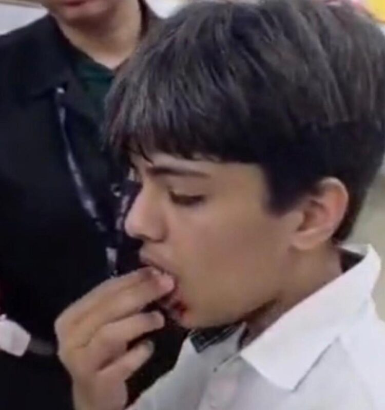 दसवीं के छात्र की पिटाई कर दांत और जबड़ा तोड़ा